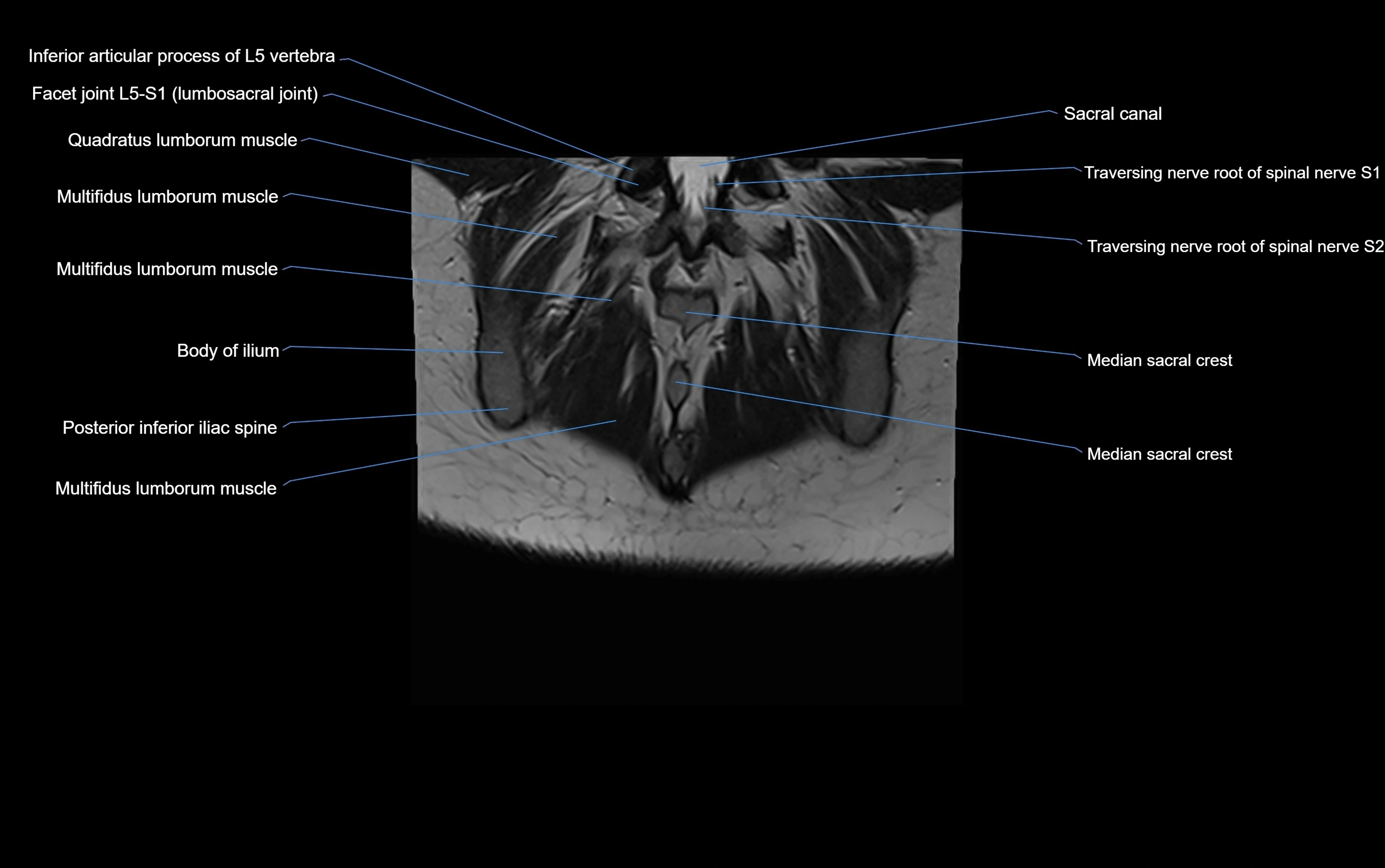 MRI sacroiliac joint coronal cross sectional anatomy  radiology  image-img-00001-00028.webp
